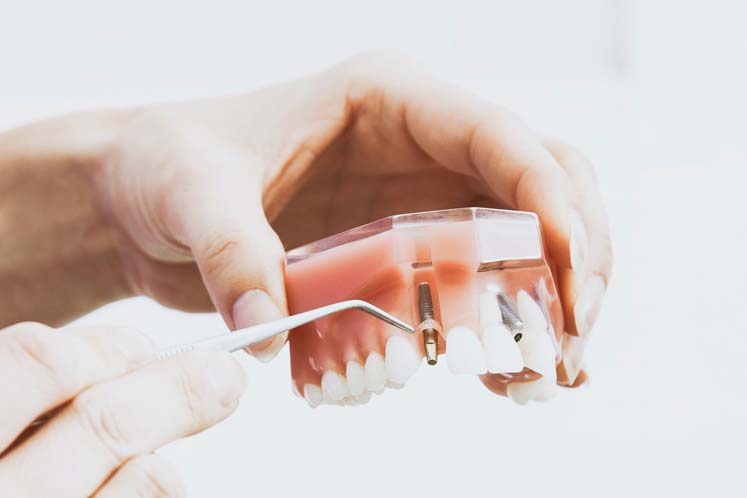 implantaten Rotterdam